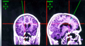 accelerated tms therapy, accelerated tms